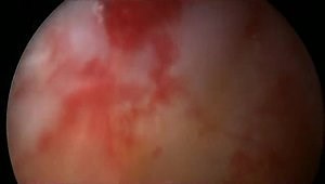 Dynamic Anterior Capsular Reconstruction Using the Long Head of the Biceps for Antero-inferior Glenuhumeral Instability