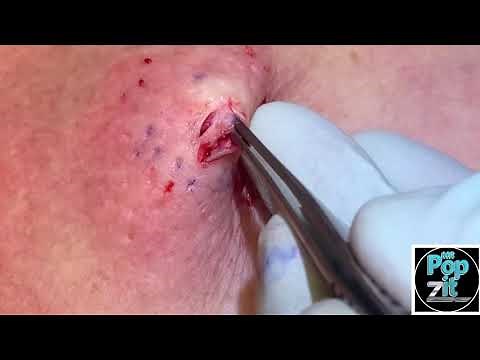Chest popper blackhead with underlying cyst. Big squeeze and cyst pop. Full excision and closure.