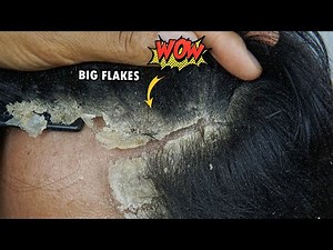 Scratching Dandruff Off Scalp With Comb #1043