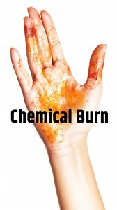 🔥 Healing Beyond the Surface: Chemical Burn Treatments🔥 Chemical burns require specialized care, and in this video, @plasticsurgeonsb , a leading plastic surgeon and burn wound specialist, dives deep into: 🌟 Advanced techniques like skin grafting, fat grafting, lasers, and expanders 🌟 Targeted treatments for areas like the scalp, eyelids, neck, and ears 🌟 Restoring normalcy and improving scars Don’t let chemical burn scars define your life—there’s hope and effective solutions available. 🎥C