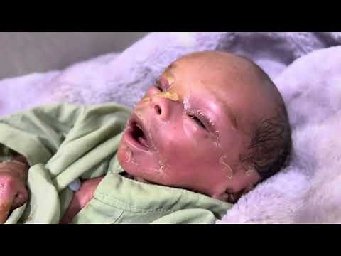 Collodion Baby Returns After 7 Days | Emotional Follow-Up & Home Care Update | NICU Follow-Up