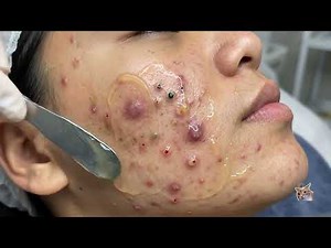 Extreme Acne Extraction Compilation 2026 🤯