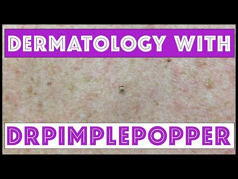 A Day in Dermatology with Dr Pimple Popper
