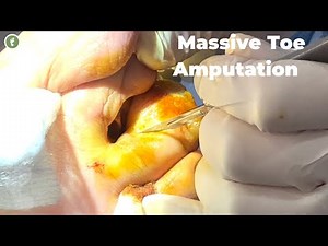 STEP-BY-STEP MASSIVE TOE AMPUTATION