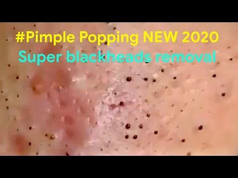 Pimple Popping 2020 Video #02| Blackheads, Whiteheads & Inflamed removal acne treatment