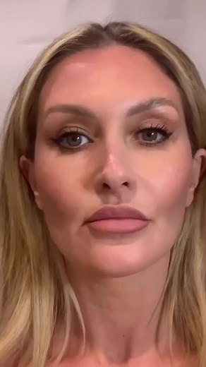 Did you know we can improve Marionette lines with dermal fillers? Want to know more about these types of treatments? And more importantly what treatments will suit you? Say “yes” for a copy of my FREE EBook or to know more about this treatment! | Million Dollar Face