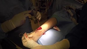 Minimally Invasive Achilles Tendon Repair