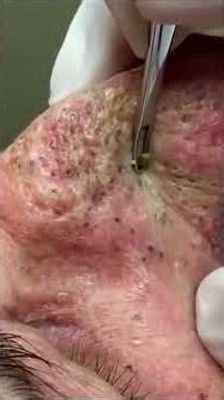 Blackheads Don't Stand a Chance with Dr Pimple Popper