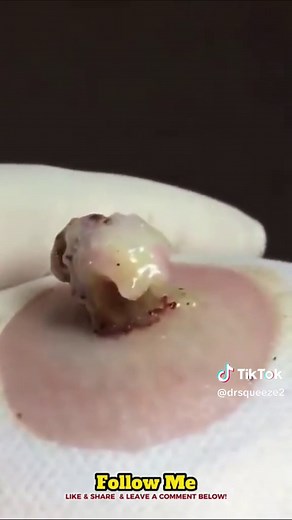 Giant Cyst Removal Procedure Explained