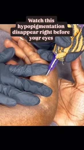 💫Hypopigmentation on darker skin tones can be emotionally exhausting, especially when it’s visible and hard to hide. 🌟Today’s client came in with light patches that no makeup could cover. But paramedical tattooing did what concealer couldn’t: restored her confidence by matching the pigment to her natural tone.💕 🌟Camouflage is not just cosmetic—it’s transformational. 💫 💬 Have a scar or light patch that bothers you? 📲 DM me to see if you’re a good candidate for skin camouflage. ✨ You deserv