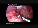 Sleeve Gastrectomy - How I Do It • Video • MEDtube.net