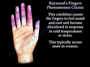 Raynaud's Fingers Phenomenon classic - Everything You Need To Know - Dr. Nabil Ebraheim