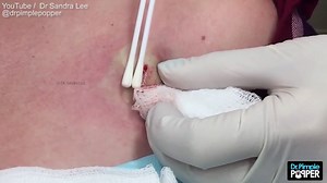 Pimple popping passion: Treat and drain an inflamed cyst