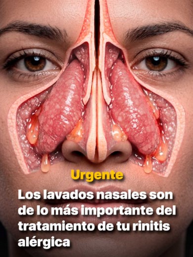 Lavado nasal rinitis alérgica: cómo y por qué hacerlo correctamente