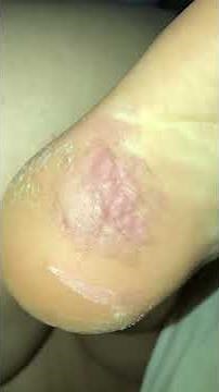 Foot picking session (Dermatillomania)