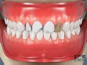 This video demonstrates how the installation of veneers goes. Take a look! #glasgowmedicalcenter #orthodontist #dentist #dubai #invisalign #inmanaligner #eonaligner #incognitobraces #lingualbraces #damonbraces #braces | Glasgow Medical Center, Dubai