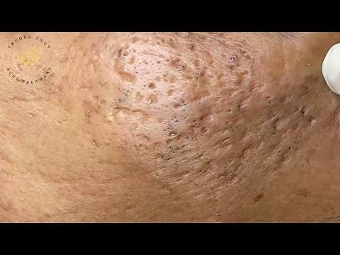 Acne Treament Under The Skin #029