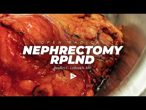 Open Radical Nephrectomy RPLND by Bradley C. Leibovich, MD | Preview