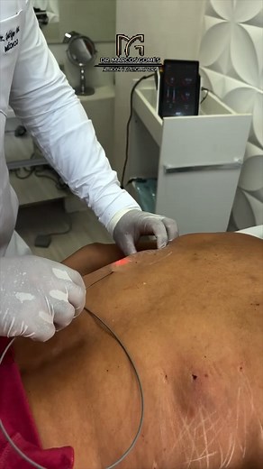 ✅Endolift, the newest and best technology to dissolve fat and tighten sagging skin, you don’t need to have surgery to have a beautiful body without sagging, ask us how✅✅✅ ✅Endolift, la nueva y mejor tecnología para disolver grasa y tensar la piel flácida, no necesitas operarte para tener un cuerpo hermoso sin flacidez, pregúntanos cómo✅✅✅ | Dr Marcos Gomes