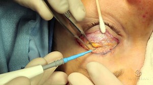 live-surgery-upper-blepharoplasty-eyelid-lift-part-2-resection-and-results