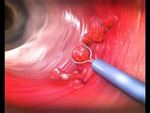 Colonscopic Polypectomy | Cold & hot biopsy- polyp| Snare technique | Dr Rams Medical Coding Academy