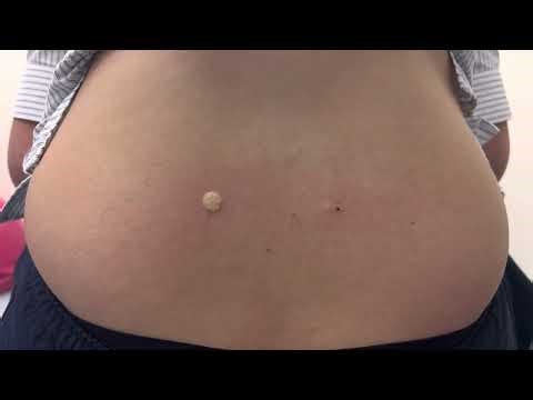 Sterile Water Injections for back pain