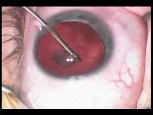 Cataract Surgery For Posterior Lenticonus  • Video • MEDtube.net