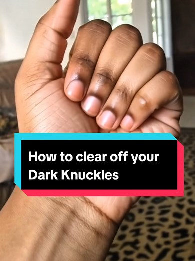 How to Clear Dark Knuckles Fast: Simple Home Remedy