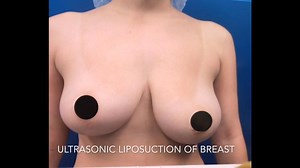 3 Months Post-Op Ultrasonic Liposuction of the Breast to Correct Asymmetry