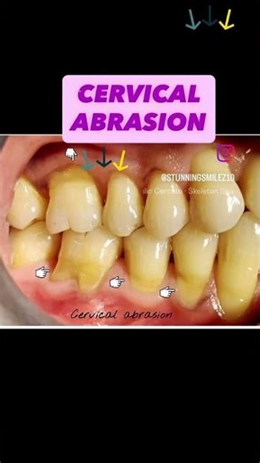 DENTAL CERVICAL ABRASION: It’s the loss of tooth structure at the neck of the tooth..