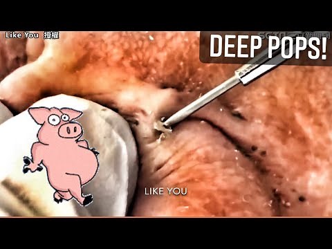 Whiteheads! Biggest Pimples Popping and Top 10 Comedones! Zits