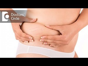 Does Laser Treatment help in reducing stretch marks & how much will it cost? - Dr. Urmila Nischal