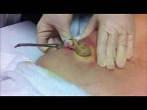 AMAZING CYST REMOVAL!! VERY SATISFYING!!!!