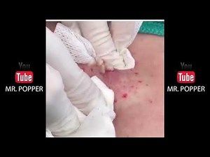 SO SATISFYING Mr Popper pops some BIG NASTY pimples in this one!!