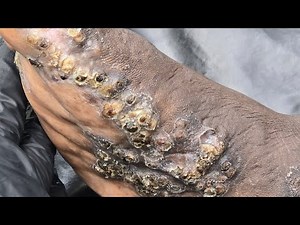Joab, jiggered father, many bugs - see long videos @ riseupsociety.net & ruskenya.org