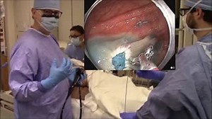 Have you seen the latest SUTAB Tip of the Week? ASGE President Douglas K. Rex, MD, MASGE provides an Introduction to Hot Avulsion. Visit the full library of short colonoscopy tips. https://bit.ly/2ROAYsE #SUTAB #Colonoscopy #Gastroenterology #ASGE | American Society for Gastrointestinal Endoscopy - ASGE