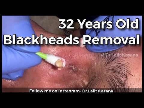 35 YEARS OLD DEEP BLACKHEAD REMOVAL BY DR.LALIT KASANA / NEW BLACKHEAD VIDEO