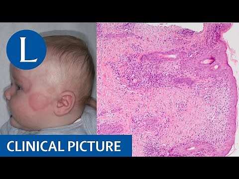 A baby with red plaques on the face and first-degree heart block: neonatal lupus