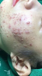 44K views · 319 reactions | OMG!!! To much pimple face !!! | Pimple Stuff | Facebook