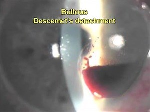 Descemet's Detachment Classification & Relaxing Descemetotomy - Eyetube