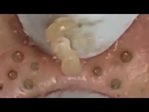 Deep blackhead extraction Cystic acne & pimple popping #4