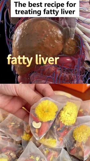 Healthy Liver Detox Drink Recipe for Chronic Liver Disease