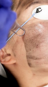 The China Doll Laser Peel, also known as the Carbon Laser Peel, is a...