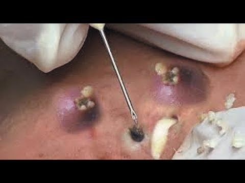 Blackheads and Cysts Removal Collection