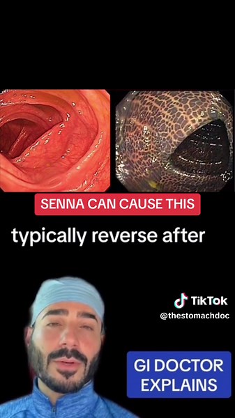 What long term senna can make your colon look like #senna #constipation