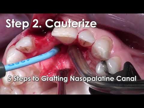 5 Easy Steps to Grafting the Nasopalatine Canal