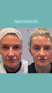 ✨ Another gorgeous transformation with Dr Pod ✨ This beauty had a full-face refresh using a tailored mix of Aptos & PDO Threads – giving lift, contour, and definition where it’s needed most. 🌟 Brow lift 🌟 Midface lift 🌟 Lower face tightening 🌟 Neck rejuvenation 🌟 Softer nasolabial folds 🌟 Defined lip outline The power of threads = natural, youthful, long-lasting results 💎 📍 @thepeppermintgroup 👩🏻‍⚕️ @drritapoddar #aptosthreads #aptos #threadlift #facialthreads #pdo #pdothreads #aptosth