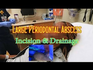 Periodontal Abscess Incision