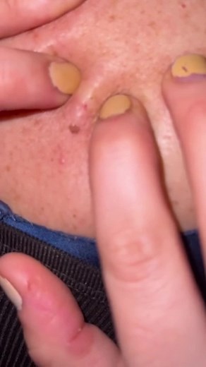 Recurring Blackhead Removal on Mom's Back