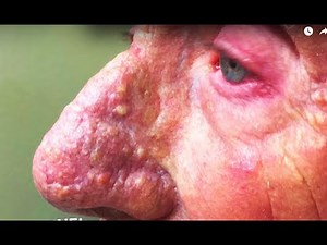 Dr. Pimple Popper's Worst Blackhead and Cyst Video - Logan Paul